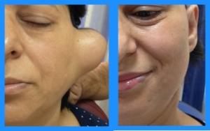 TÜKRÜK BEZİ TÜMÖRLERİ